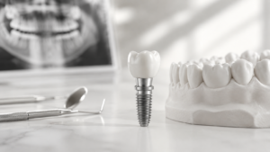 Implantes Dentários: Técnicas Modernas que Aceleram o Processo de Colocação dos Dentes